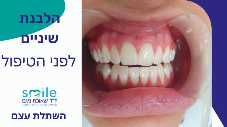 הלבנת שיניים זכרון יעקב