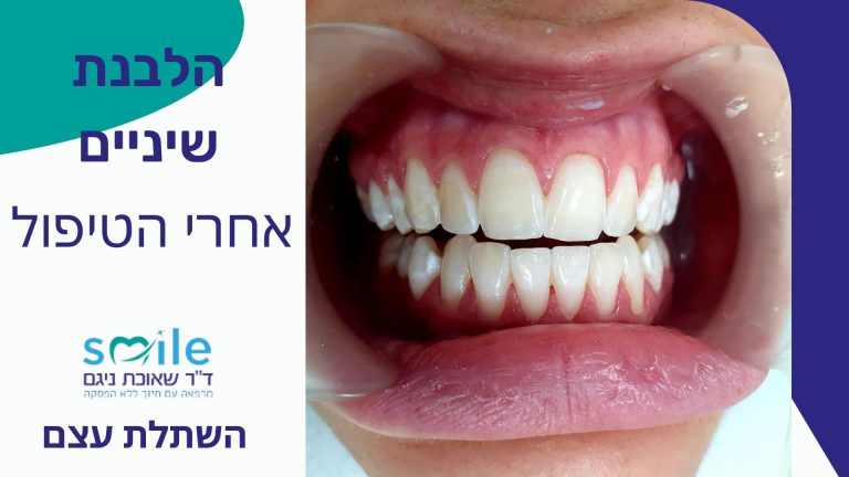 הלבנת שיניים זכרון יעקב