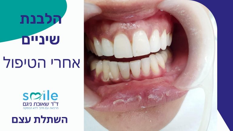 הלבנת שיניים זכרון יעקב