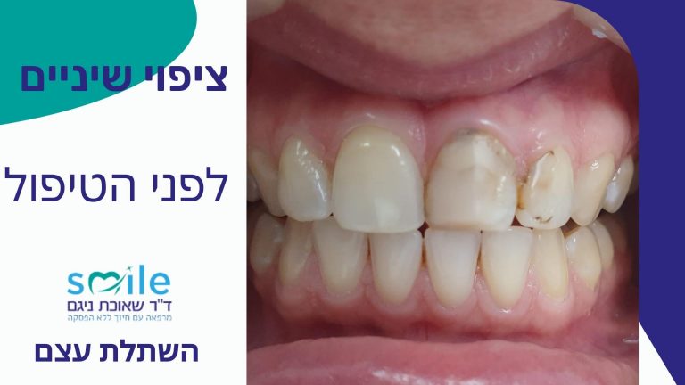 ציפי שיניים זכרון יעקב