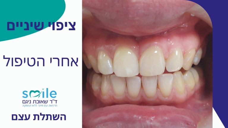 ציפי שיניים זכרון יעקב