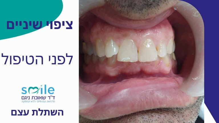 ציפי שיניים זכרון יעקב