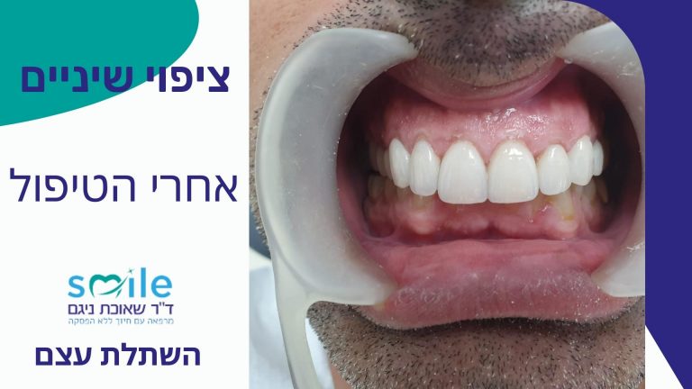 ציפי שיניים זכרון יעקב