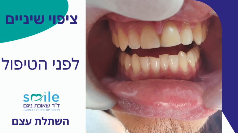 ציפוי שיניים בזכרון יעקב