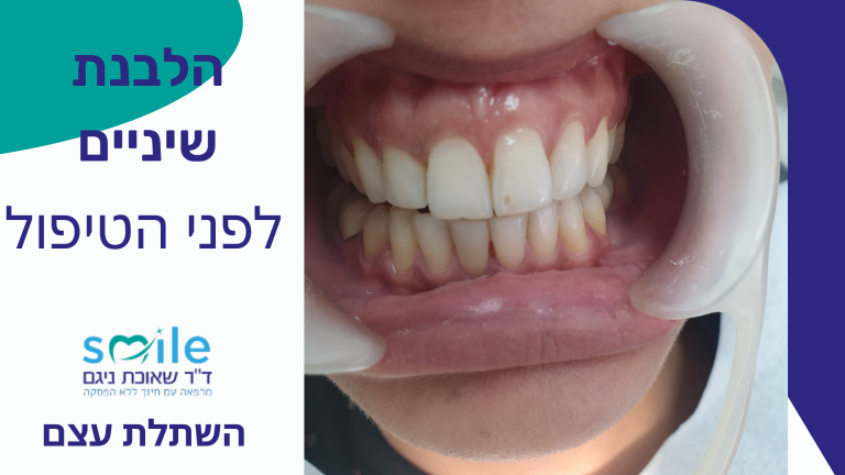 הלבנת שיניים זכרון יעקב