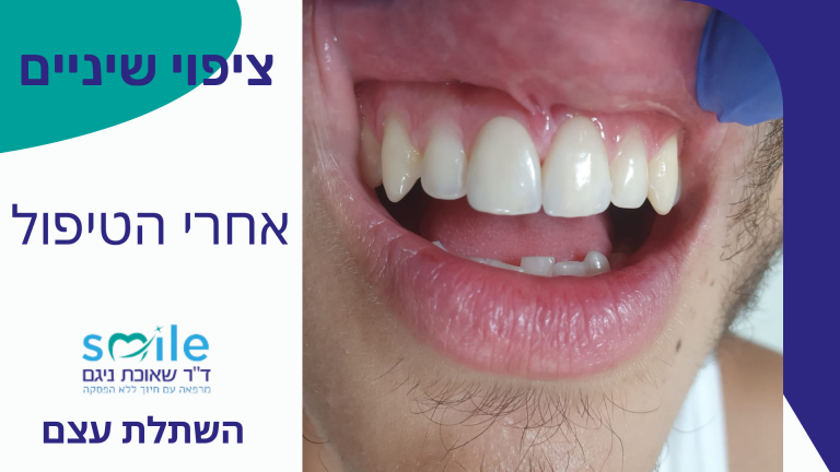 ציפוי שיניים בזכרון יעקב