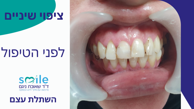 ציפוי שיניים בזכרון יעקב