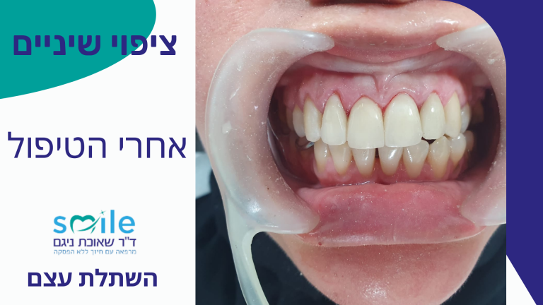 ציפוי שיניים בזכרון יעקב